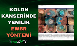 Kolon Kanserinde Yenilik EWBR Yöntemi
