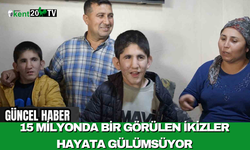 15 Milyonda Bir Görülen İkizler Hayata Gülümsüyor