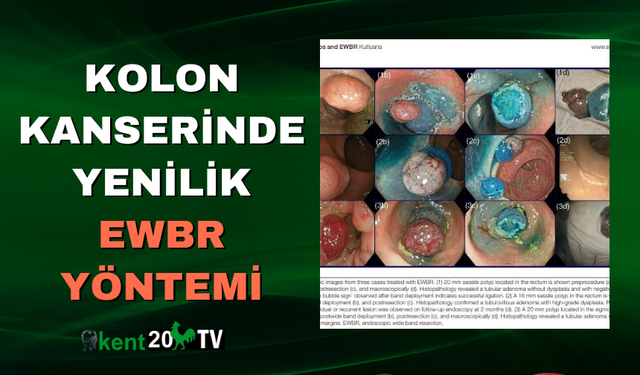 Kolon Kanserinde Yenilik EWBR Yöntemi