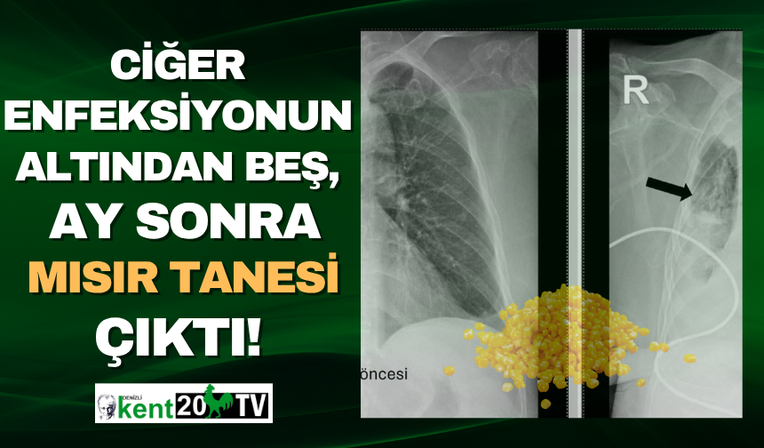 Denizli'de nefes borusuna kaçan mısır, beş ay sonra çıkarıldı!